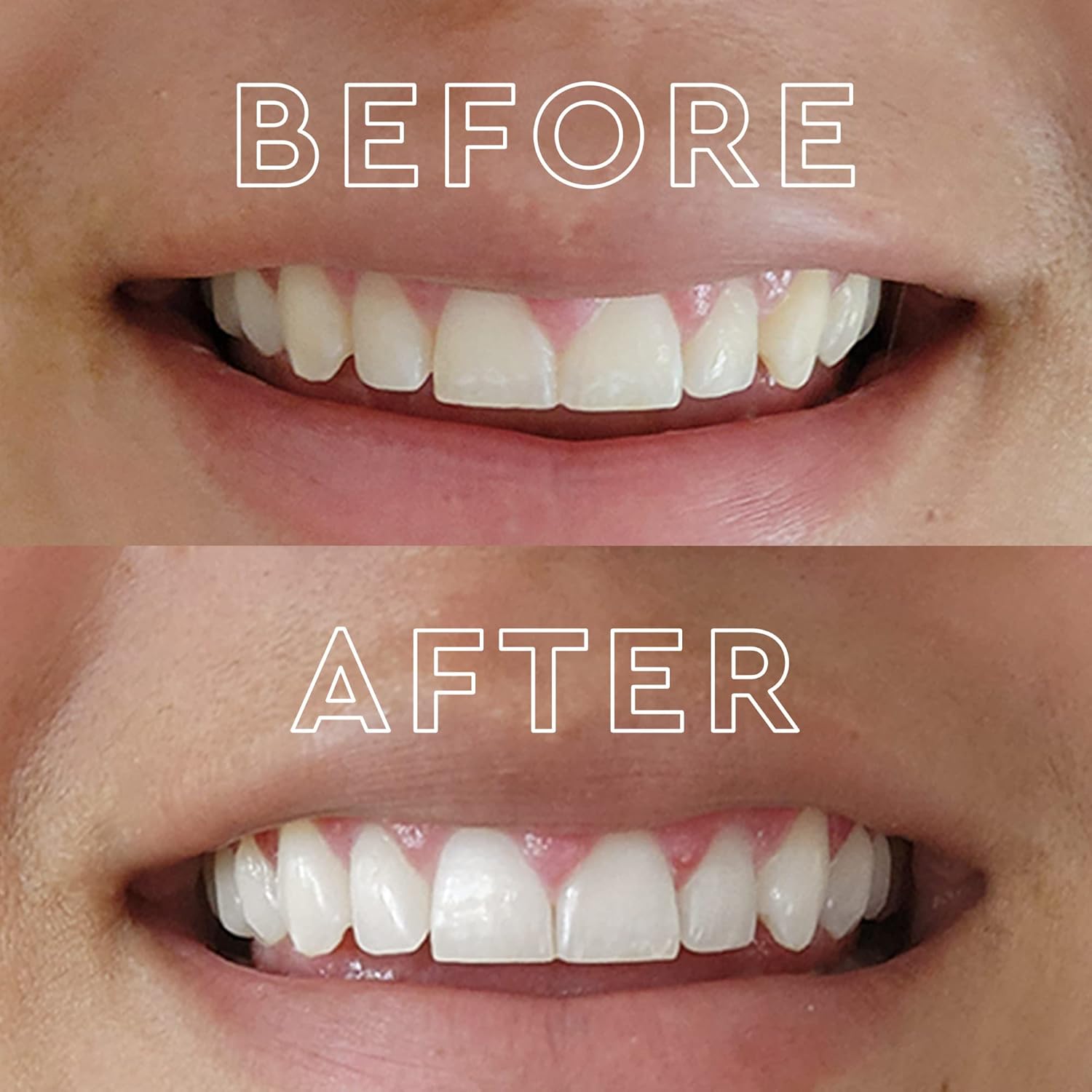 LED Teeth Whitening Kit with 5 - Teeth Whitening Strips recensie en prijs